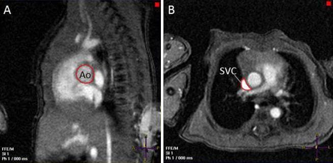 This diagnostic imaging panel features two phase-contrast magnetic resonance imaging (PC MRI) frames used for cardiovascular flow quantification in a newborn. Image A is a sagittal view demonstrating the measurement of left ventricular output (LVO) at the level of the aortic valve. The aorta is highlighted with a red circle and labeled 'Ao,' situated at the superior aspect of the heart representing the left ventricular outflow tract. Image B is an axial (transverse) cross-section at the level of the pulmonary trunk, focused on superior vena cava (SVC) flow quantification. The SVC is traced with a red outline, revealing its characteristic crescent or asymmetric shape as it molds against the adjacent ascending aorta before entering the right atrium. These images illustrate the technical application of PC MRI in assessing neonatal hemodynamics, specifically comparing blood flow volumes in the systemic outflow (LVO) versus systemic venous return (SVC). The modality provides high-resolution anatomical landmarks and precise cross-sectional area measurements essential for calculating cardiac output and shunt fractions in pediatric cardiology.