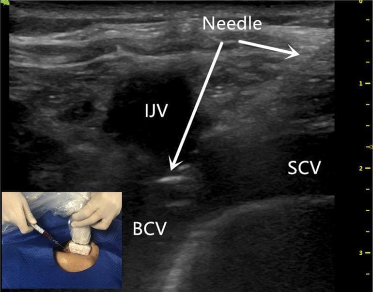 Diagnostic ultrasound image demonstrating the anatomy and procedure for ultrasound-guided central venous cannulation via the brachiocephalic vein (BCV). The primary B-mode image shows the BCV in a longitudinal view, characterized as a large hypoechoic (anechoic) vascular lumen in the lower portion of the frame. Superior and adjacent to it are the internal jugular vein (IJV), appearing as a dark circular structure, and the subclavian vein (SCV). A hyperechoic needle is visualized using an in-plane approach, entering from the upper right at an oblique angle. The needle tip, indicated by a white arrow, is clearly positioned within the lumen of the BCV, confirming successful vascular access. An inset clinical photograph illustrates the corresponding physical positioning of the ultrasound transducer and the syringe/needle on the patient's neck/supraclavicular region. This visual is intended for medical training in anesthesiology and emergency medicine, specifically for performing safe, real-time guided vascular access to minimize complications like pneumothorax or arterial puncture.