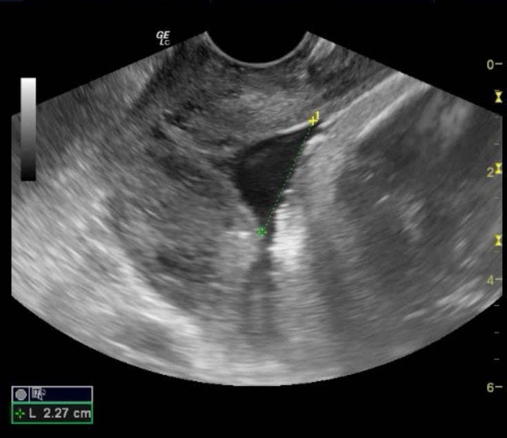 This diagnostic image is a transvaginal ultrasound in a sagittal plane focusing on the cervix during a gynecological/obstetric evaluation. The grayscale sonogram displays the anatomical structures of the cervix, including the hypoechoic (dark) cervical canal and the internal os. A linear measurement is performed across the internal cervical os, indicated by a green dotted line with calipers. The ultrasound software overlay shows a measurement value of 'L 2.27 cm', representing the diameter of the internal os opening. This measurement is clinically significant for assessing cervical ripening or the progress of labor induction, often used in conjunction with the Bishop score to predict successful cervical maturation. The anatomical orientation shows the superior uterine cavity transitioning into the cervical canal toward the lower external os. The image serves as an educational example of sonographic cervical assessment in an obstetrical context.