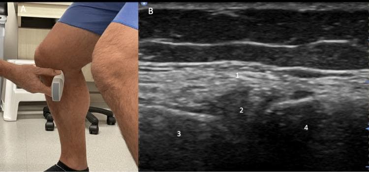 This dual-panel image demonstrates a diagnostic ultrasound examination of the medial knee joint. Panel A is a clinical photograph showing the transducer placement in a longitudinal (long-axis) orientation over the medial joint line of a standing patient with the knee flexed. Panel B is the corresponding musculoskeletal ultrasound image identifying key anatomical landmarks. The medial collateral ligament (MCL, labeled 1) is visible as a superficial, hyperechoic, fibrillar band. Deep to the MCL, the medial meniscus (labeled 2) appears as a hypoechoic, triangular, or wedge-shaped structure situated within the joint space. The underlying bony surfaces of the medial femoral condyle (labeled 3) and the proximal tibia (labeled 4) are characterized by distinct, hyperechoic cortical lines with posterior acoustic shadowing. This weighted-bearing, flexed-knee view is clinically significant for evaluating meniscal extrusion and joint space narrowing in the assessment of osteoarthritis. The educational focus is on identifying soft tissue and bony relationships in the medial compartment of the knee under functional positioning.