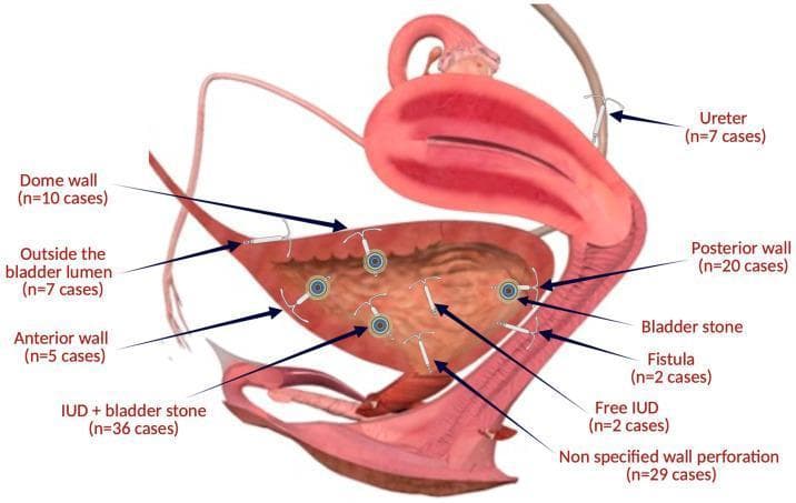 This medical anatomical diagram illustrates the various topographical sites of intrauterine device (IUD) migration and translocation into the urinary tract. The schematic depicts a sagittal view of the female pelvic anatomy, specifically highlighting the uterus, urinary bladder, and ureter. Labeled arrows indicate specific migration patterns and complications observed in clinical cases: IUDs embedded in the dome wall, anterior wall, and posterior wall of the bladder; those located outside the bladder lumen; and instances of ureteral involvement. Internal bladder complications are shown, including free-floating IUDs, non-specified wall perforations, and secondary bladder stone formation (calculi) encrusting the migrated device. The diagram also identifies IUD-related fistulas. Numerical case data (e.g., n=36 cases for IUD + bladder stone) are provided for each location, serving as a summary of clinical incidence for healthcare professionals and students studying long-term complications of contraceptive devices and secondary urological pathology.