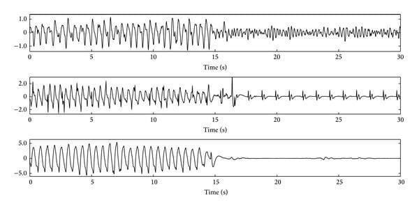 This Comparison Chart illustrates three 30-second electrocardiogram (ECG) segments from patients experiencing out-of-hospital cardiac arrest (OHCA), highlighting the impact of cardiopulmonary resuscitation (CPR) artifacts on rhythm interpretation. Each panel is divided into two 15-second phases: the first phase contains high-amplitude oscillatory artifacts caused by chest compressions, while the second phase shows the underlying rhythm after compressions cease. The top panel transitions from CPR artifact to Ventricular Fibrillation (VF), characterized by low-amplitude, disorganized, and chaotic electrical activity. The middle panel reveals Pulseless Electrical Activity (PEA), showing a transition to regular, organized QRS complexes and T-waves despite the lack of a pulse. The bottom panel demonstrates Asystole, where the cessation of CPR artifacts reveals an almost flat, isoelectric line. The visualization serves to educate on the challenge of automated rhythm analysis during active resuscitation, as CPR artifacts often overlap with the spectral and morphological characteristics of both shockable and non-shockable rhythms.