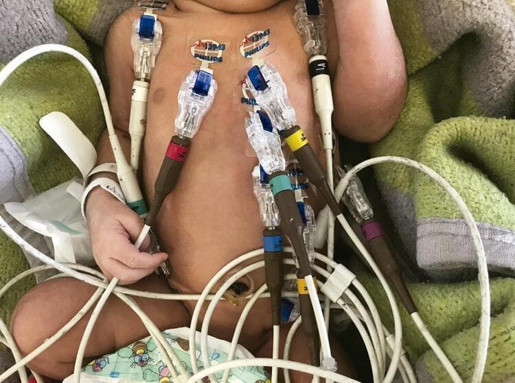 A clinical photograph illustrating the standardized placement of a 12-lead electrocardiogram (ECG) on a neonate. The image shows several electrodes secured to the newborn's skin using clear adhesive gel tabs (Philips brand). The electrode distribution follows neonatology guidelines to minimize motion artifacts: the four limb leads are positioned on the right and left shoulders and the right and left iliac crests, rather than the distal extremities. The precordial leads (V1-V6) are arranged across the anterior chest wall. Each electrode consists of a transparent plastic clip housing, a tapered brown connector with color-coded bands (including red, yellow, green, blue, and purple) for lead identification, and white cabling. The clinical context demonstrates the procedural adaptations required for neonatal cardiac monitoring, such as using torso placement for limb leads to improve signal-to-noise ratio in active infants.