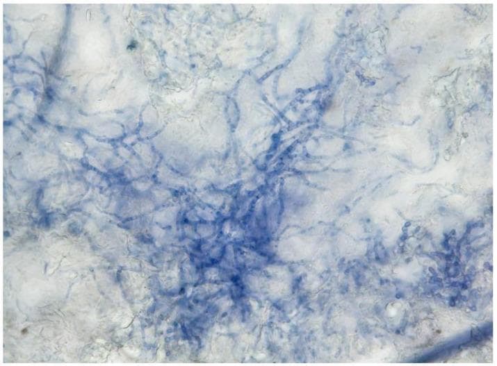 This diagnostic image shows a microscopic direct examination of a skin scrapings sample at 400x magnification. The specimen is processed using a potassium hydroxide (KOH) and Myco-Ink preparation to identify dermatophytes. The visual field demonstrates a network of septate, branching fungal hyphae stained a distinct blue by the Myco-Ink, which binds to chitin in the cell walls. The hyphae appear as elongated, filamentous structures that are intertwined and matted in some regions, typical of Trichophyton quinckeanum morphology. The KOH has cleared the surrounding keratinous epidermal debris, providing high contrast between the darkly stained fungal elements and the lighter, translucent background. This preparation is a critical clinical tool in dermatology for the rapid diagnosis of tinea infections (zoonotic dermatophytosis), allowing for the visualization of hyphal morphology, distribution, and branching patterns necessary for preliminary mycological identification.