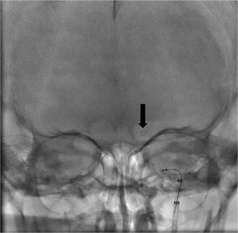 A native fluoroscopic image (X-ray) in an anteroposterior (AP) view showing a mechanical thrombectomy procedure for an ischemic stroke. The image demonstrates a radio-opaque stent retriever deployed within the intracranial vasculature. An arrow points to the distal radio-opaque markers of the device, which is positioned at the level of the left carotid terminus (the bifurcation of the internal carotid artery into the middle cerebral artery and anterior cerebral artery). Below this, the proximal delivery catheter and markers are visible as they ascend through the cervical and petrous segments of the internal carotid artery. The surrounding cranial anatomy, including the calvarium, orbits, and petrous ridges, provides anatomical context for the endovascular positioning. This clinical image illustrates a key step in interventional neuroradiology where the device is used to engage and extract a thrombus to restore cerebral perfusion.