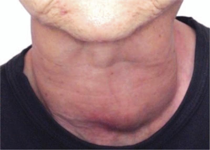 This clinical photograph shows the anterior neck region of a patient with significant, diffuse thyroid gland enlargement, characteristic of a massive goiter. The swelling is centrally located and extends vertically from the submandibular region (lower jawline) down to the suprasternal notch and upper chest. Anatomically, the mass obscures the normal contours of the larynx, trachea, and sternocleidomastoid muscles. The goiter appears lobulated with multiple prominent convexities, particularly on the inferior aspect. The overlying skin is stretched, showing horizontal neck creases and areas of mild erythema, likely due to mechanical pressure and tissue expansion. This visual represents a severe manifestation of thyroid disease, such as Graves' disease or multinodular goiter, illustrating the significant anatomical distortion of the neck structures and its clinical relevance in endocrinology and surgical evaluation.