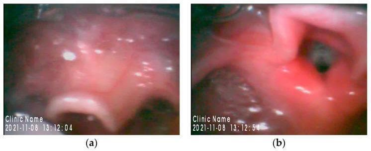 This dual-panel clinical photograph displays airway anatomy via video laryngoscopy using a Glidescopeยฎ. Image (a) focuses on the epiglottis, which appears relatively large, thickened, and curvilinear with a smooth, glistening mucosal surface. This view is typical of the initial phase of laryngoscopy where the epiglottis is visualized prior to lifting it to expose the glottis. Image (b) shows the glottic opening, classified as Cormack-Lehane Grade 2. The dark, elliptical glottic aperture is partially visible, flanked by the aryepiglottic folds and posterior laryngeal structures which appear pink and well-perfused. These images illustrate the airway assessment of a pediatric patient with MillerโDieker syndrome, a condition associated with potential difficult intubation due to craniofacial and anatomical variations. The visual documentation is essential for anesthesiology education, highlighting the use of video-assisted intubation techniques to navigate complex neonatal or pediatric airways.
