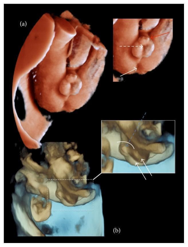 This diagnostic image presents a three-dimensional (3D) ultrasound surface rendering of male fetal external genitalia, illustrating severe congenital anomalies. The rendering is divided into two primary views (a and b) with associated insets and annotations. The images demonstrate a shortened penis with a characteristic ventral curvature known as chordee. A prominent surplus of prepucial tissue is visible at the distal end, forming a 'prepucial cap' or dorsal hood, a typical finding in hypospadias. Annotations highlight the suspected ectopic location of the urethral meatus at the base of the penis near the interscrotal fold, rather than at the glans tip. The scrotum appears bifid with two distinct scrotal folds, within which both testicles are visualized as descended. The transverse view (b) emphasizes the ventral angulation and the spatial relationship between the penis, scrotum, and perineum. This visual configuration is highly characteristic of a third-degree (severe) hypospadias. The image serves as an educational tool for prenatal diagnosis of genital malformations and demonstrates the utility of 3D ultrasound in mapping anatomical structural relations for surgical planning.