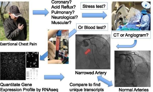 This scientific illustration and flowchart describe a clinical research study design evaluating blood-based RNA biomarkers for Coronary Artery Disease (CAD). The workflow begins with a clinical photograph of a patient experiencing exertional chest pain, prompting a differential diagnosis (Coronary, Acid Reflux, Pulmonary, Neurological, or Muscular). Diagnostic pathways shown include stress tests and blood tests, leading to imaging via CT or Angiogram. Radiological images illustrate the comparison between 'Normal Arteries' and a 'Narrowed Artery' (indicated by a red arrow). The research component is depicted through a photograph of a blood sample collection and a visualization of quantitative gene expression profiling via RNAseq. The final stages involve comparing transcriptomic data from 'LOW CAD' (<20% stenosis) and 'MID+ CAD' (>20% stenosis) groups to identify unique transcripts. The diagram effectively bridges clinical presentation, diagnostic imaging (angiography), and molecular biology techniques (RNA sequencing) to define a methodology for cardiovascular biomarker discovery.