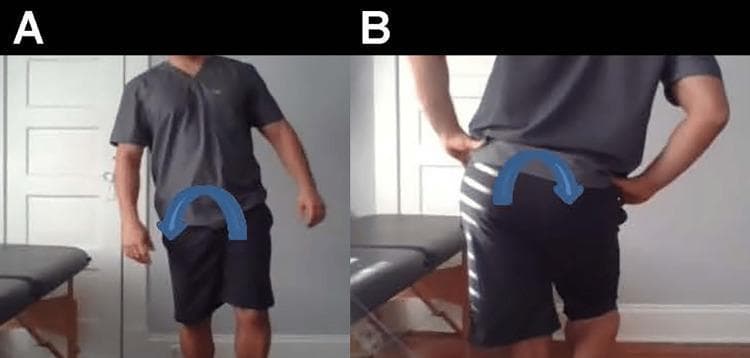 Clinical photograph sequence illustrating a positive Trendelenburg sign and compensated Trendelenburg gait. Image A presents an anterior view of an individual during the stance phase on the left leg. There is a visible lateral trunk lean (compensated gait) toward the stance side, indicated by a blue curved arrow, to maintain pelvic stability despite hip abductor weakness. Image B provides a posterior view demonstrating a significant pelvic drop on the contralateral (right) side while standing on the left leg, indicated by a blue downward-curving arrow. This pelvic tilt reflects insufficiency of the gluteus medius and minimus muscles on the weight-bearing side. The sequence highlights key physical examination findings for hip abductor weakness, typically assessed in sports medicine, orthopedics, and physical therapy to diagnose conditions like gluteal tendinopathy or superior gluteal nerve palsy.