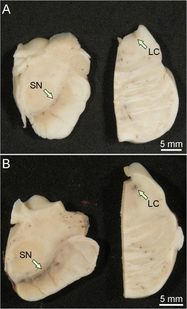 This clinical photograph shows a macroscopic comparison of post-mortem human brain tissue specimens from the midbrain and pons. The image is divided into two panels: (A) representing a brain with Lewy body disease and (B) representing a healthy control. Green arrows indicate two critical anatomical landmarks: the substantia nigra (SN) in the midbrain sections and the locus coeruleus (LC) in the pontine sections. In the control sample (B), both the SN and LC exhibit distinct, dark pigmentation due to the presence of neuromelanin. In the Lewy body disease sample (A), there is a significant and visible loss of this neuromelanin pigment, resulting in a pale appearance of these nuclei. This depigmentation is a hallmark pathological finding in synucleinopathies such as Parkinson's disease and Dementia with Lewy Bodies, reflecting the progressive loss of dopaminergic neurons in the substantia nigra and noradrenergic neurons in the locus coeruleus. A 5 mm scale bar is provided for anatomical reference.