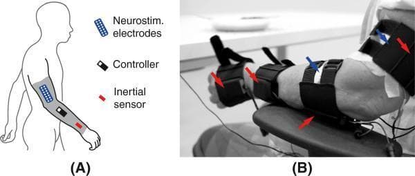 This medical visual consists of two panels depicting a neuroprosthetic (NP) system for upper limb tremor management. Panel A is an anatomical diagram showing the concept design: a continuous textile sleeve on a human arm integrating neurostimulation electrodes (blue), a controller (black), and inertial sensors/gyroscopes (red). Panel B is a clinical photograph of the functional prototype in a modular configuration applied to a patient's arm. The prototype includes four black textile supports secured with adjustable straps around the hand, forearm, and upper arm. Red arrows identify integrated solid-state gyroscopes within these supports, while blue arrows indicate transcutaneous neurostimulation electrodes placed directly on the skin over specific muscle groups (e.g., extensor carpi radialis and biceps brachii). The system uses real-time kinematic data from the gyroscopes to deliver adaptive transcutaneous electrical stimulation, inducing muscle co-contraction to stabilize joints and suppress pathological tremors associated with conditions like Parkinson's disease and essential tremor.