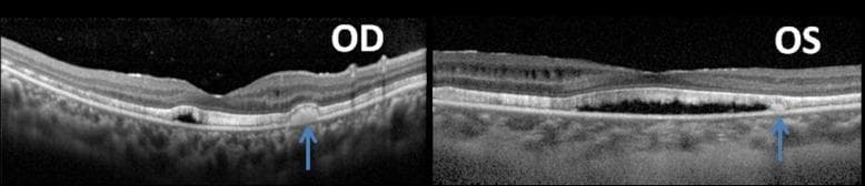 Diagnostic Image: Optical Coherence Tomography (OCT) cross-sections of the right (OD) and left (OS) eyes of a 23-year-old female patient. The images demonstrate several pathological findings characteristic of complex retinal disease. Both scans show a diffused shallow serous neuroretinal detachment and thinning of the retinal nerve fiber layer. There are clear parafoveal intraretinal fluid collections (cystoid spaces) present within the macular retinal layers. Blue arrows indicate discrete, hyperreflective subretinal accumulations located between the sensory retina and the retinal pigment epithelium (RPE). Additionally, both eyes exhibit significant elongation and thickening of the photoreceptor outer segment layer. These features are clinically significant for evaluating conditions involving fluid redistribution, such as uveitis, central serous chorioretinopathy, or secondary effects of angle-closure glaucoma post-surgical intervention. The OCT provides high-resolution visualization of the retinal architecture, allowing for the differentiation between intraretinal edema and subretinal exudative material.
