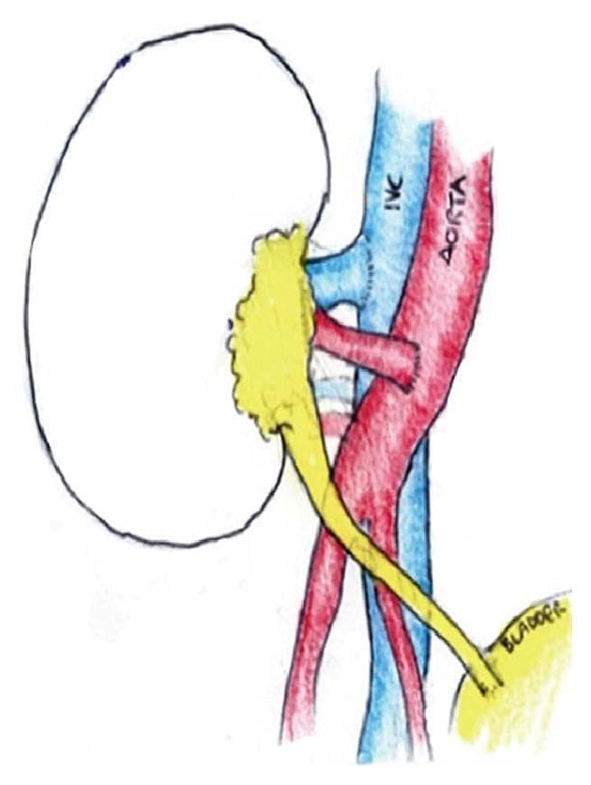 This medical schematic diagram illustrates a kidney transplantation procedure, focusing on the vascular and urinary tract reconstruction. The diagram depicts the donor kidney with its hilum oriented toward the recipient's major vessels. The vascular anastomosis is shown with the donor renal artery (in red) connected to the distal abdominal aorta and the donor renal vein (in blue) connected to the inferior vena cava (IVC). In this specific clinical scenario, the anatomical arrangement reflects a midline laparotomy approach for implantation onto the great vessels rather than the standard iliac fossa placement, often necessitated by complex recipient vascular anatomy. The urinary tract reconstruction is demonstrated by a yellow tubular structure representing the ureter, extending from the renal pelvis and draining into the bladder, labeled at the bottom right. The illustration serves as an educational tool for understanding heterotopic kidney transplant techniques and surgical anatomy in cases of congenital vascular abnormalities.