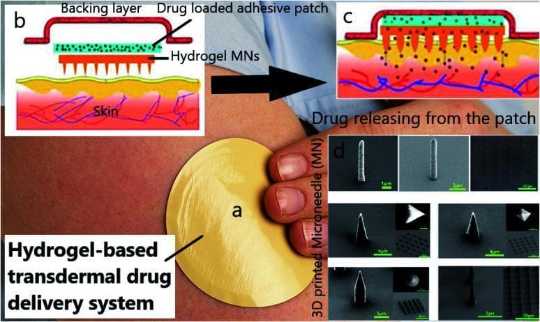 This composite educational graphic illustrates a hydrogel-based transdermal drug delivery system (TDDS). (a) A clinical photograph showing the application of a circular, tan adhesive patch to human skin. (b) A cross-sectional anatomical diagram detailing the patch's structural layers: an outer 'Backing layer,' an internal 'Drug loaded adhesive patch' containing therapeutic molecules (green dots), and a bottom layer of 'Hydrogel MNs' (microneedles). (c) A pathophysiology diagram demonstrating the clinical application, where the microneedles penetrate the stratum corneum to facilitate drug diffusion into the dermal capillary system (depicted by blue and red vascular structures). (d) High-magnification Scanning Electron Microscopy (SEM) images displaying various 3D-printed microneedle morphologies, including cylindrical, conical, and pyramidal shapes with scale bars ranging from 1μm to 20μm. The visual educational focus is on the mechanism of minimally invasive drug administration and the importance of microneedle architecture in enhancing skin permeability for systemic or localized therapy.
