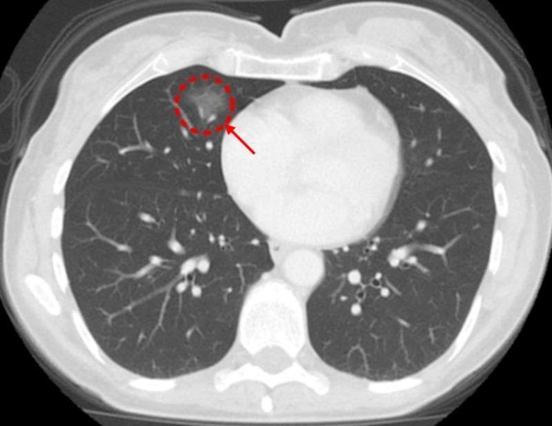This diagnostic image is an axial slice from a computed tomography (CT) scan of the chest, presented in a lung window setting. The primary finding is a focal area of ground-glass opacity (GGO) in the right lung, specifically located within the right middle lobe near the anterior cardiophrenic angle. The lesion is highlighted by a red dashed circle and indicated by a red arrow. Visually, the GGO presents as a region of hazy, increased attenuation that does not obscure the underlying pulmonary vasculature or bronchial walls, a hallmark of alveolar or interstitial lung processes. The mediastinal structures, including the heart and great vessels, appear within normal limits on this slice. The surrounding lung parenchyma is clear, with no signs of pleural effusion or significant lymphadenopathy visualized at this level. This imaging finding is clinically significant for evaluating pulmonary manifestations of systemic inflammatory diseases, such as Crohn's disease, or assessing early-stage neoplastic processes. The image is appropriate for medical education focusing on thoracic radiology and the interpretation of non-specific alveolar opacities.