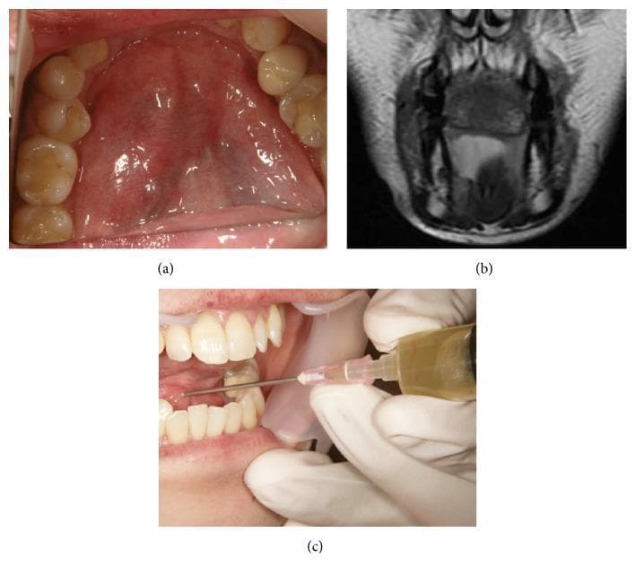 This composite of clinical and diagnostic images documents a sublingual ranula in a 38-year-old patient. Figure (a) is a clinical photograph of the floor of the mouth showing a dome-shaped, translucent blue-tinted swelling consistent with a mucous extravasation cyst or ranula, adjacent to the lower dentition. Figure (b) is a coronal T2-weighted MRI scan demonstrating a well-circumscribed, hyperintense (bright) cystic lesion in the right sublingual space, which indicates high fluid content and confirms the extent of the ranula. Figure (c) depicts the clinical procedure of fine-needle aspiration. A syringe is shown extracting yellowish, mucinous fluid from the lesion, a hallmark diagnostic feature of saliva-containing cysts. The collection of images illustrates the diagnostic pathway from clinical presentation and radiological imaging to procedural confirmation of a sublingual ranula, relevant for oral and maxillofacial surgery and dental education.