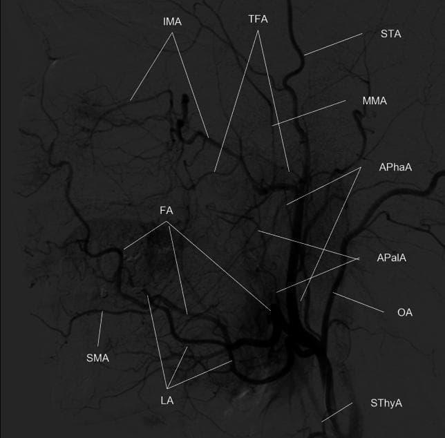 This diagnostic image is a Digital Subtraction Angiogram (DSA) of the human head and neck, specifically showing a lateral view of the external carotid artery (ECA) and its branching patterns. The image serves as a high-resolution anatomical reference for the vascular supply to the face, scalp, and deep facial structures. Key vessels identified via labels include the superior thyroid artery (SThyA), lingual artery (LA), facial artery (FA), occipital artery (OA), and the ascending pharyngeal artery (APhaA). The facial artery (FA) is shown emerging anteriorly, giving rise to the ascending palatine (APalA) and submental (SMA) arteries. Superiorly, the internal maxillary artery (IMA) is visible with its mandibular and pterygoid segments, alongside the middle meningeal artery (MMA). The terminal branches of the ECA, including the superficial temporal artery (STA) and the transverse facial artery (TFA), are also clearly delineated. This visualization is characteristic of interventional radiology and vascular anatomy studies used for planning procedures such as intra-arterial chemotherapy or embolization for head and neck cancers.