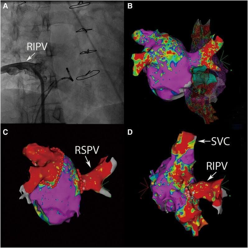 This composite figure illustrates diagnostic imaging and electroanatomical mapping related to pulmonary vein anatomy and surgical intervention. Panel A is an intracardiac angiogram showing the right inferior pulmonary vein (RIPV) opacified with contrast as it connects to the right atrium; metallic sternal wires from a prior cardiothoracic surgery are visible superiorly. Panels B, C, and D display 3D electroanatomical maps generated by the CARTO system, which use color coding to represent cardiac voltage or activation times. Purple typically indicates high voltage (healthy tissue), while red and warmer colors represent lower voltage or specific anatomical borders. Panel C depicts the isolation of normally connected pulmonary veins, including the right superior pulmonary vein (RSPV), with ablation points marked as red dots. Panel D shows an anomalous connection of the right inferior pulmonary vein (RIPV) and identifies the superior vena cava (SVC). This image set is designed for advanced medical education in cardiac electrophysiology and the management of anomalous pulmonary venous return.