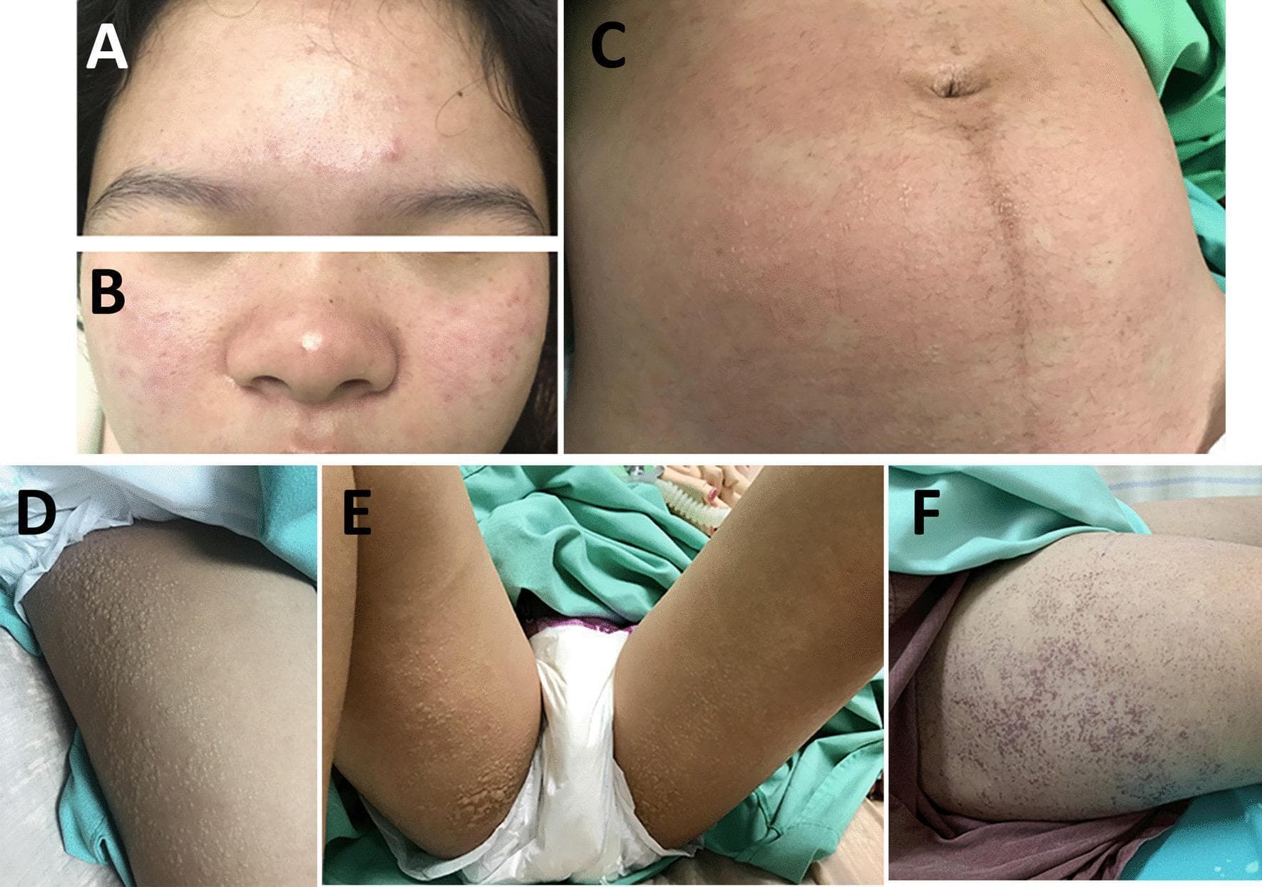 This composite clinical photograph displays the progression and distribution of skin lesions in a patient with Chikungunya fever. Panels A and B show the facial involvement, characterized by an erythematous maculopapular rash distributed across the forehead, malar region (cheeks), and nose. Panel C illustrates the abdominal wall, exhibiting multiple small, clear vesicles superimposed on a diffuse erythematous maculopapular background. Panels D and E depict the bilateral upper thighs, showing numerous non-hemorrhagic vesicles and small bullae. Panel F reveals a later stage of progression on the right thigh, where the lesions have evolved into discrete, coalescing, and hemorrhagic vesicles with visible crusting. The images demonstrate the polymorphic nature of the cutaneous manifestations of Chikungunya virus infection, ranging from initial maculopapular erythema to vesiculobullous and hemorrhagic stages, which is particularly significant in severe clinical presentations or specific patient populations.