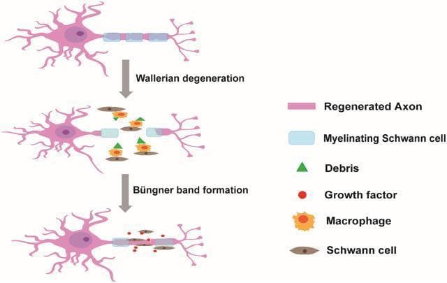 A pathophysiology diagram illustrating the stages of peripheral nerve injury (PNI) repair and the role of Schwann cells. The process is depicted in three vertical steps. Step 1 shows an intact regenerated axon (pink) with segmented myelinating Schwann cells (light blue). Step 2, labeled 'Wallerian degeneration,' shows axonal fragmentation in the distal stump, myelin breakdown into debris (green triangles), and the recruitment of macrophages (orange). Step 3, labeled 'Büngner band formation,' demonstrates the regenerative phase where activated Schwann cells (brown ovals) align to form a supportive path, secreting growth factors (red dots) to guide the re-growth of the axon from the proximal stump toward the distal target. The diagram highlights the transition of Schwann cells from a myelinating state to a repair-promoting state, facilitating clearance of debris and subsequent axonal guidance through specialized cellular columns known as bands of Büngner.