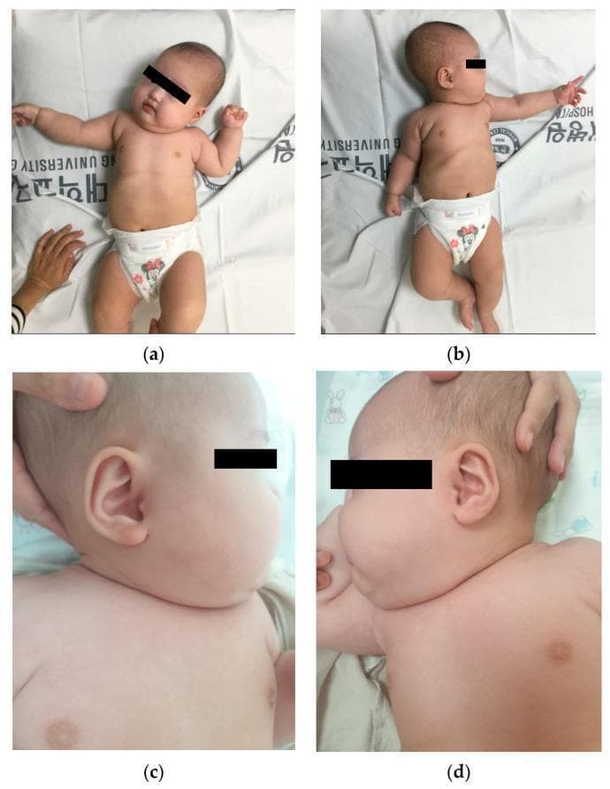 This set of four clinical photographs displays a 2-month-old infant with significant right-sided hemihyperplasia and associated muscular torticollis. Panel (a) and (b) provide full-body views in the supine position, demonstrating marked somatic asymmetry where the right upper and lower extremities appear significantly larger in circumference and volume compared to the contralateral left side. An asymmetric tonic neck reflex is captured in both orientations. Panels (c) and (d) present lateral close-up views of the head and neck. Image (c) shows the right side with visible fullness of the facial and neck soft tissues and a postural tilt, while image (d) provides a comparison of the left side. The visual findings illustrate clinical manifestations of hemihyperplasia, an overgrowth syndrome characterized by the asymmetric enlargement of one or more body parts. The neck positioning is consistent with congenital muscular torticollis, likely secondary to sternocleidomastoid muscle involvement on the hyperplastic side, resulting in a restricted range of motion toward the left.