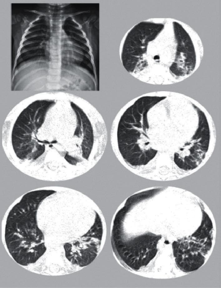 This composite diagnostic image features a pediatric chest X-ray in the top left and five axial CT scans of the chest from the same patient. The chest X-ray demonstrates diffuse, subtle increased density within the lung fields and a prominent cardiac silhouette. The axial CT images, presented in lung window settings, reveal bilateral ground-glass opacities (GGO) with a predominantly peripheral and posterior distribution. Several areas show more dense consolidative changes, and some lesions exhibit the 'halo sign,' characterized by a nodular opacity surrounded by a ring of ground-glass attenuation. The heart appears moderately enlarged relative to the thoracic cavity. These findings are consistent with multi-system inflammatory syndrome in children (MIS-C) related to COVID-19, highlighting the spectrum of pulmonary involvement ranging from interstitial inflammation to parenchymal consolidation.