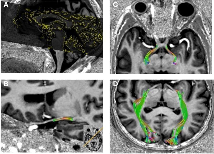 This diagnostic image composite demonstrates the visual pathway using 7T high-resolution MRI and Diffusion Tensor Imaging (DTI) with selective deterministic tractography. Panel A shows a sagittal view with a DTI slab overlay delineated by yellow contours, covering the extent of the visual system. Panel B displays a sagittal reconstruction highlighting the optic tract as a colored fiber bundle. Panel C provides a coronal view of the bilateral optic tracts as they emerge from the optic chiasm and extend toward the lateral geniculate nucleus (LGN). Panel D shows a coronal section illustrating the optic radiations, visualized as expansive colored fiber bundles traveling from the LGN to the primary visual cortex in the occipital lobes. The fiber bundles utilize a standard color-coding scheme representing diffusion directionality (e.g., green for anteroposterior, red for mediolateral, and blue for craniocaudal). This imaging serves to assess axonal integrity and white matter pathway alterations in neurodegenerative conditions such as Normal Tension Glaucoma (NTG).