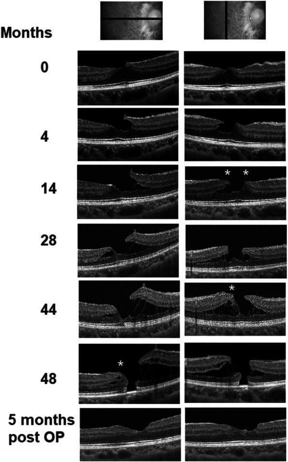 This composite diagnostic image features a series of Spectral-Domain Optical Coherence Tomography (SD-OCT) B-scans documenting the progression and treatment of a macular pathology over a 4-year period. The sequence illustrates the evolution of a lamellar macular hole (LMH) into a full-thickness macular hole (FTMH). At month 0, initial vitreoretinal traction is visible. By month 4, a tractional LMH forms, characterized by an irregular foveal contour. From month 14 to 44, the scans demonstrate the development of epiretinal proliferation (EP), marked by asterisks (*), appearing as medium-reflective material on the inner retinal surface. Concurrently, there is progressive dehiscence of the retinal layers and increasing foveal thinning. At month 48, the pathology has transitioned to a FTMH with complete discontinuity of all neurosensory retinal layers, including the ellipsoid zone. The final row, labeled '5 months post OP', shows the anatomical outcome following a pars plana vitrectomy with an inverted internal limiting membrane (ILM) flap; the scans demonstrate a successfully sealed macular hole with restored retinal continuity and improved macular architecture.