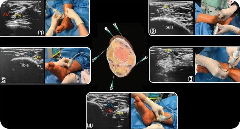 A composite medical educational figure demonstrating ultrasound-guided ankle block techniques for five terminal nerves. A central cross-sectional anatomical diagram of the ankle identifies needle trajectories for the deep peroneal (1), superficial peroneal (2), sural (3), posterior tibial (4), and saphenous (5) nerves. Surrounding this are five numbered panels, each pairing a high-frequency ultrasound scan with a clinical photograph of the transducer and needle placement. (1) Deep Peroneal Nerve (DPN) shown lateral to the anterior tibial artery (ATA) over the tibia. (2) Superficial Peroneal Nerve (SPN) visualized as hyperechoic clusters in the subcutaneous tissue superficial to the fascia near the fibula. (3) Sural Nerve (SUN) identified adjacent to the small saphenous vein (V). (4) Posterior Tibial Nerve (PTN) shown posterior to the posterior tibial artery (PTA) and veins (PTV) at the medial malleolus, exhibiting a classic honeycomb echotexture. (5) Saphenous Nerve (SAN) demonstrated adjacent to the great saphenous vein (SV) over the medial tibia. This resource is designed for anesthesiology training and regional anesthesia protocol development.