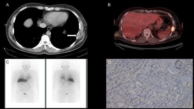 A composite clinical and diagnostic image set illustrating a case of metastatic paraganglioma with succinate dehydrogenase (SDH) deficiency. (A) Axial CT scan of the thorax shows an expansile, lytic-appearing metastatic deposit in the left 8th rib (indicated by a white arrow). (B) Axial 18F-FDG PET/CT fusion image demonstrates intense radiotracer uptake (avidity) at the site of the left rib lesion, indicating high glucose metabolism within the tumor. (C) Coronal I131-MIBG whole-body planar scans (anterior and posterior views) show a complete lack of tracer uptake at the rib metastasis site, highlighting the diagnostic limitation of MIBG for certain SDH-deficient neuroendocrine tumors. (D) Photomicrograph of tumor histology with SDHB immunohistochemistry (IHC) staining. The tumor cells show a diffuse loss of granular cytoplasmic staining (immunonegativity), while background stromal elements or internal controls show normal expression. This IHC pattern is a surrogate marker for deficiency in the SDH complex, specifically associated here with a germline SDHA mutation. The images demonstrate the multi-modal diagnostic approach and pathological correlation for evaluating malignant paragangliomas.
