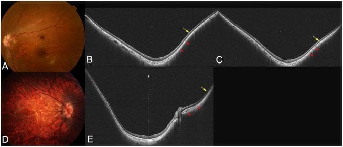 This composite figure illustrates the clinical and diagnostic imaging findings of pathologic myopia and macular staphyloma using fundus photography and wide-field optical coherence tomography (WF-OCT). (A, D) Fundus photographs demonstrate characteristic myopic changes: Image A shows peripapillary diffuse chorioretinal atrophy (PDCA), while Image D reveals more advanced diffuse chorioretinal atrophy with multiple lacquer cracks and prominent tessellation. (B, C, E) Cross-sectional WF-OCT scans highlight the morphological alterations of a staphyloma. Key features include posterior displacement of the sclera in the staphylomatous area and localized scleral inward protrusions (indicated by yellow arrows) marking the staphyloma edge. The choroid displays dynamic thickness changes, thinning as it approaches the staphyloma edge and re-thickening toward the posterior pole or optic nerve. Red arrowheads point to areas where the inner sclera is displaced posteriorly corresponding with choroidal re-thickening. These images serve as educational tools for identifying the structural boundaries and retinal-choroidal thinning associated with high axial length and posterior staphyloma progression.
