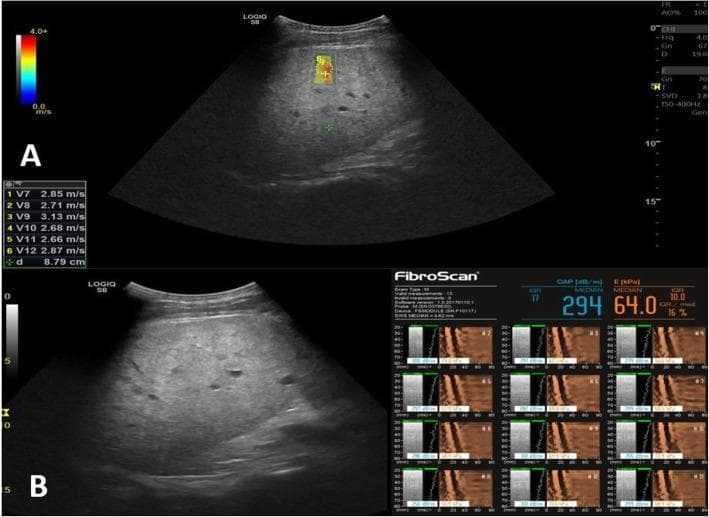 This composite diagnostic image demonstrates non-invasive liver fibrosis assessment in a 52-year-old male with chronic hepatitis C. Panel A displays a 2D Shear Wave Elastography (SWE) ultrasound of the liver. It features a B-mode grayscale image with a colored elasticity map overlay. A color-coded scale (0.0 to 4.0 m/s) indicates tissue stiffness, where red signifies higher shear wave velocity. Measurement data shows velocity values ranging from 2.66 to 3.13 m/s (median 2.62 m/s), corresponding to a Metavir F4 (cirrhosis) stage. Panel B shows a FibroScan (Transient Elastography) interface. Quantitative findings include a Controlled Attenuation Parameter (CAP) of 294 dB/m (indicating hepatic steatosis) and a liver stiffness measurement (E) of 64.0 kPa with an IQR/median ratio of 16%. The FibroScan display includes individual measurement graphs showing shear wave propagation. Both modalities consistently indicate advanced fibrosis/cirrhosis (F4). This content is representative of hepatology and radiology diagnostic protocols for monitoring chronic liver disease progression.