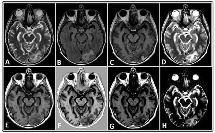 A comparison panel of axial brain MRI sequences from a 40-year-old male with brain metastasis. The top row (A-C) shows standard clinical acquisitions: (A) T2-weighted (T2w), (B) T2-weighted Fluid Attenuated Inversion Recovery (FLAIR), and (C) T1-weighted (T1w) post-contrast. The remaining images (D-H) are synthetically generated (MAGiC): (D) T2w, (E) T1w, (F) Phase-Sensitive Inversion Recovery (PSIR), (G) T1w FLAIR, and (H) Short Tau Inversion Recovery (STIR). The images demonstrate a focal lesion in the left occipital region, which appears hyperintense on T2w and FLAIR sequences and shows significant enhancement on the post-contrast T1w image (C). The synthetic images (D-H) replicate key tissue contrasts, such as bright CSF in T2w (D) and STIR (H), suppressed CSF signal in FLAIR (B, G), and the characteristic gray-white matter differentiation of T1w (E) and PSIR (F). This clinical image set illustrates the utility of synthetic MRI in obtaining multiple diagnostic weightings from a single rapid acquisition.
