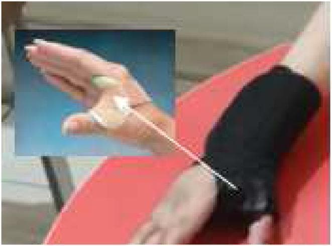 This clinical photograph displays a web spacer splint applied to a pediatric hand, an orthotic device commonly used in physical and occupational therapy for conditions like hemiplegic cerebral palsy (HCP). The splint is designed to manage thumb-in-palm deformity and spasticity by maintaining the thumb in a functional abducted position. The device consists of two primary materials: a rigid or semi-rigid light-colored thermoplastic component situated directly within the first dorsal web space to provide structural support, and a black neoprene fabric sleeve that wraps around the wrist and hand for stabilization and comfort. An inset image provides a close-up view of the thermoplastic spacer's positioning between the thumb and index finger. A white arrow points toward the base of the thumb, indicating the vector of support or the anatomical focus of the intervention. This visual illustrates a conservative management strategy for improving hand function and maintaining range of motion in patients with hypertonicity of the adductor pollicis.