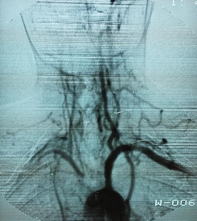 This diagnostic image is an arteriography of the aortic arch and supra-aortic trunks. The imaging captures the major arterial branches, including the brachiocephalic trunk, the left common carotid artery, and the left subclavian artery. Significant vascular pathology is demonstrated through several key visual features: there is a distinct proximal stenosis of the brachiocephalic trunk shortly after its origin from the aorta. Both the right and left common carotid arteries exhibit a markedly narrowed, 'filiform' (thread-like) appearance as they ascend the neck, indicating significant luminal reduction. Additionally, the right subclavian artery shows a decreased diameter in its distal segment compared to the more robust appearance of the left subclavian artery. These findings are characteristic of Takayasu arteritis, demonstrating the diffuse parietal thickening and resulting stenoses of large-vessel vasculitis. The image serves as a clinical example of large-vessel involvement in systemic inflammatory diseases, illustrating how arterial morphology changes under conditions of chronic wall inflammation and remodeling.