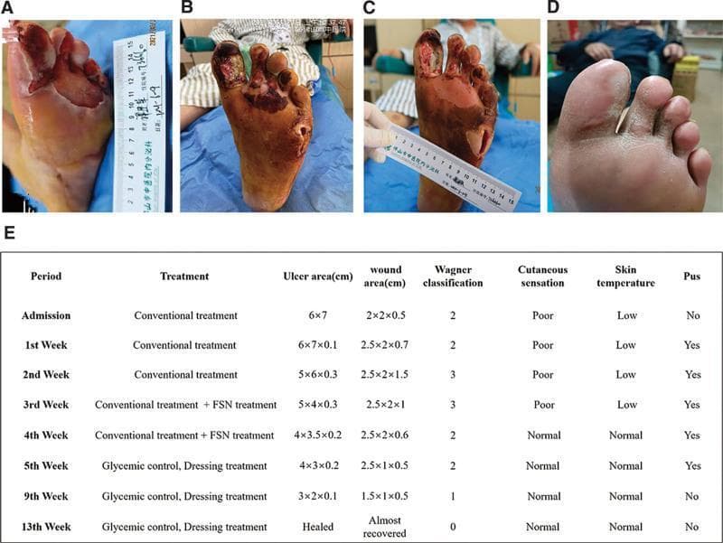 This composite figure presents a clinical progression timeline of a complex diabetic foot ulcer (DFU) on the left foot, categorized under the Wagner classification system. (A) Initial presentation shows a large, 6x7 cm ulcer on the plantar forefoot with surrounding maceration and a lateral abscess. (B) Following initial debridement, the wound exhibits deep tissue involvement (Wagner Grade 3), with necrotic tissue extending to the tendons and musculature of the first through third toes, accompanied by a deep 2x2x0.7 cm abscess cavity. (C) Mid-treatment status demonstrates significant clinical improvement; the wound bed appears ruddy with healthy granulation tissue, reduced exudate, and diminishing necrotic debris. (D) Final follow-up at three months shows complete secondary intention healing with full epithelialization and stable scar tissue formation. (E) An accompanying summary table provides longitudinal data on treatment phases (including Fu's subcutaneous needling), ulcer/wound dimensions, Wagner grade transition (from Grade 3 to 0), and clinical markers such as cutaneous sensation, skin temperature, and presence of pus.