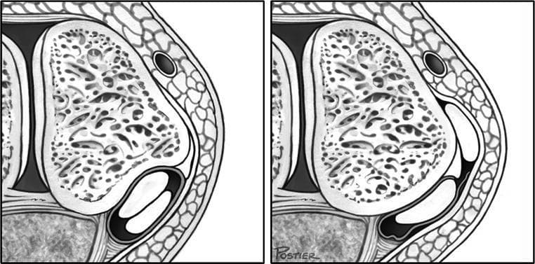 This medical illustration presents two side-by-side axial diagrams of the lateral ankle, contrasting normal anatomy with peroneal tendon subluxation. Both frames detail the lateral malleolus with its characteristic trabecular bone pattern and smooth outer cortex. The left frame illustrates the normal anatomy of the superior peroneal tunnel, where the peroneal tendons (specifically the peroneus longus) are securely positioned in the retromalleolar groove behind the lateral malleolus, stabilized by an intact superior peroneal retinaculum (SPR). The right frame demonstrates a pathological subluxation/dislocation, showing the peroneal tendon displaced anteriorly over the lateral malleolus due to a failure or disruption of the SPR. This comparison serves as an educational tool for orthopedics and sports medicine, highlighting the biomechanical importance of the retinaculum in preventing tendon instability. The diagram is relevant for understanding acute ankle injuries, chronic tendon instability, and the rationale for surgical interventions like retinacular repair or groove deepening.
