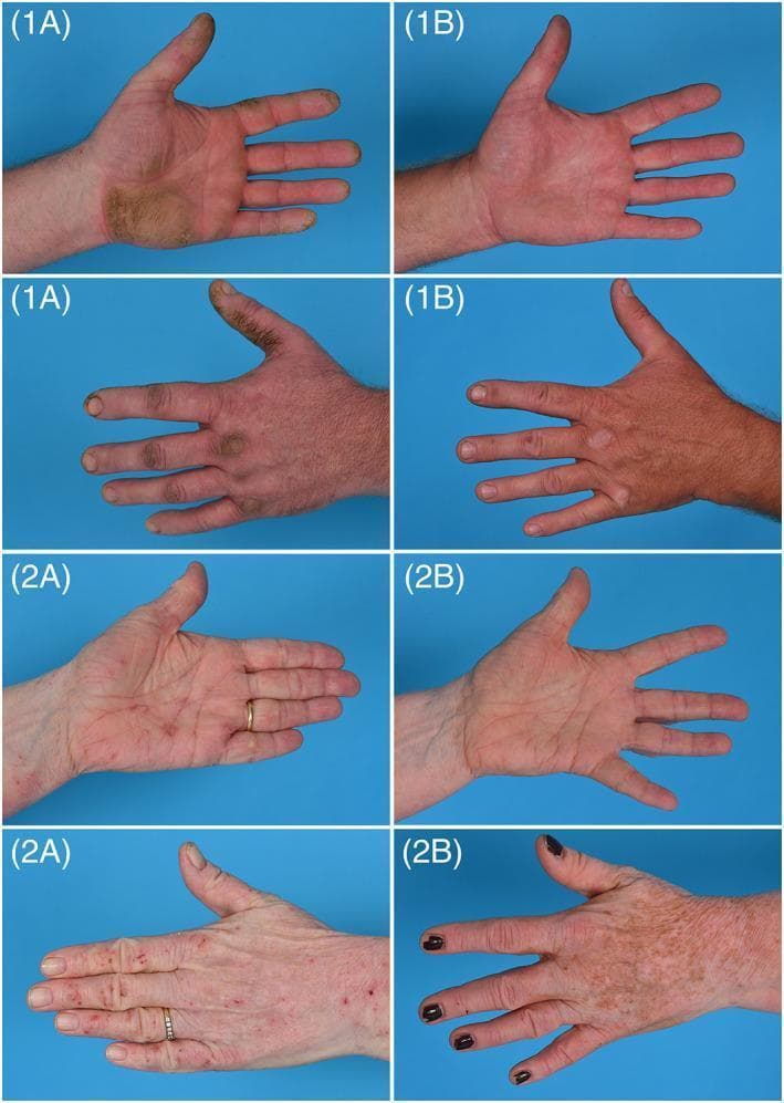 This set of clinical photographs demonstrates the therapeutic progression of two patients with chronic hand eczema (CHE) over a 16-week period. The images are organized into Case 1 and Case 2, displaying both palmar and dorsal views at baseline (A) and follow-up (B). Case 1 (1A) illustrates severe hyperkeratotic CHE, characterized by thick, yellowish, calloused plaques on the palm and fingers with associated erythema. By week 16 (1B), the hyperkeratosis has nearly resolved, showing smooth skin with minimal residual redness. Case 2 (2A) shows severe atopic CHE with diffuse erythema, scaling, and excoriations on the palmar surface, and erythematous papules and lichenification on the dorsal side. At week 16 (2B), there is a significant reduction in active inflammation and scaling on the palm, while the dorsal view shows post-inflammatory hyperpigmentation and clearance of acute lesions. The comparison highlights the efficacy of systemic treatment in managing severe, treatment-resistant hand eczema, focusing on the reduction of hyperkeratosis, erythema, and scaling to improve patient quality of life.
