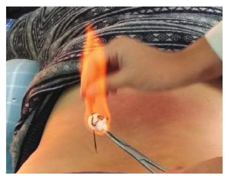 This clinical procedural photograph demonstrates fire-needle moxibustion, a technique in Traditional Chinese Medicine (TCM). The image shows a practitioner's hand using a metallic surgical clamp or forceps to hold a thin, dark acupuncture needle that has been inserted perpendicularly into the patient's skin, likely at a localized acupoint on the torso. A cotton ball soaked in a flammable substance is ignited, creating a bright orange flame that engulfs the distal end of the needle to heat it during the procedure. The surrounding skin displays a localized patch of mild erythema (redness), representing an inflammatory response to the thermal stimulation or the needling itself. This image serves as an educational example of integrative medicine, specifically showing the application of heat through a high-temperature-resistant needle to treat conditions like osteoarthritis or chronic pain. The procedural focus highlights the interaction between clinical tools, thermal elements, and the physiological skin response in external therapies.