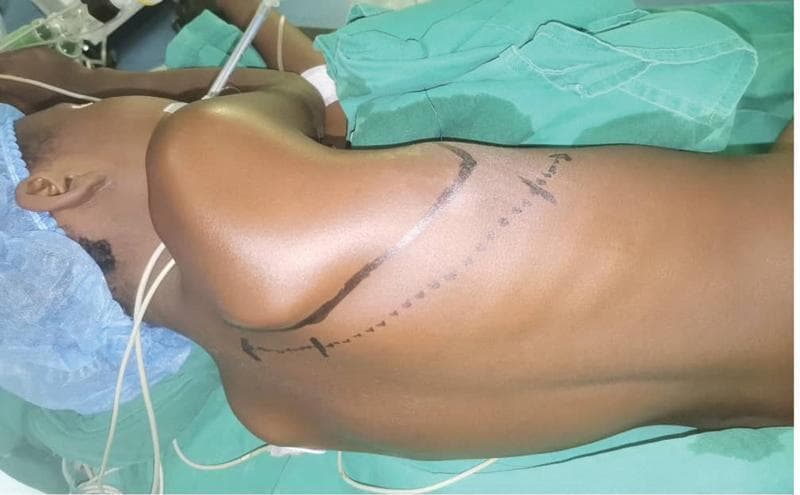 This clinical photograph demonstrates the preoperative surgical positioning and skin marking for a posterolateral thoracotomy in a patient with spontaneous pneumothorax. The patient is placed in the lateral decubitus position on an operating table, lying on their healthy side with the upper arm extended anteriorly toward the head to facilitate surgical access. A surgical marker has been used to delineate the incision site. The marking consists of a solid angled line, where one branch follows the line of the spinous processes and the other aligns with the spinal edge of the scapula. A dotted line bisects this angle, representing the planned cutaneous incision path. The positioning is designed to provide optimal exposure of the thoracic cavity while minimizing muscle sectioning, specifically targeting the planes between the latissimus dorsi, trapezius, serratus anterior, and rhomboid muscles. Visible equipment includes surgical drapes, a surgical cap, and anesthesia tubing.