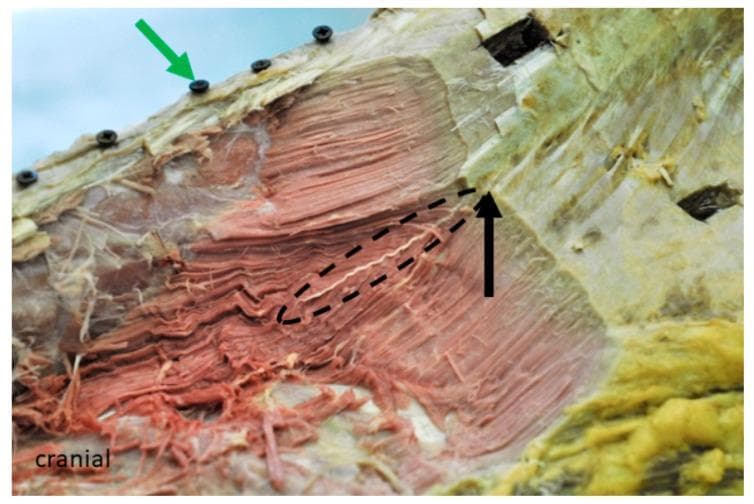 This clinical anatomical photograph shows a cranio-lateral view of a formalin-fixed dissection of the lumbar longissimus muscle (LG) at the level of the 16th rib. The specimen displays the complex architecture of muscle fascicles within the thoracolumbar region. A green arrow indicates a reference screw inserted into the spinous process of the 15th thoracic vertebra (T15), used for spatial digitization and CT alignment. The dissection reveals the internal organization of the muscle, where a prominent fascia (indicated by a black arrow) bifurcates the muscle into suprafascial and subfascial bellies. The fascicles in the dorsal compartment exhibit a more horizontal, parallel orientation, while deeper layers show varying pennation angles as they originate from the inner fascia. The tissue appears pale due to formalin fixation, and the overlying aponeurosis has been partially ablated to expose the multifidus muscle origin and the deeper fascicular pathways. This visual serves as an educational reference for understanding paraspinal muscle compartmentalization and functional anatomy in biomechanical modeling.