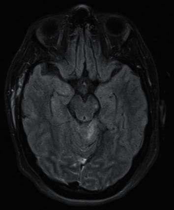 This diagnostic image is an axial Fluid-Attenuated Inversion Recovery (FLAIR) MRI of the human brain. The scan displays a cross-section at the level of the midbrain and upper pons. The image reveals Grade III Diffuse Axonal Injury (DAI), characterized by focal hyperintense (bright) lesions located in the left side of the midbrain and the pons. These signal abnormalities indicate edema or axonal shear injury against the darker, normal brain parenchyma. Surrounding anatomical structures include the temporal lobes, cerebral hemispheres with visible gyri and sulci, and the skull. The cerebrospinal fluid (CSF) within the ventricles and cisterns appears hypointense (dark), which is characteristic of the FLAIR sequence used to suppress water signal and highlight pathology. The image demonstrates the typical radiological appearance of severe traumatic brain injury affecting deep brainstem structures, which is clinically significant for assessing prognostic outcomes in trauma patients.