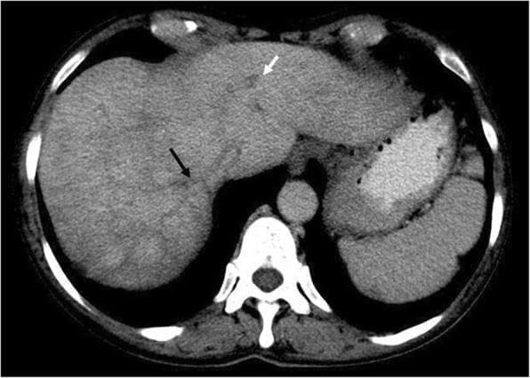 This diagnostic image is an axial computed tomography (CT) scan of the upper abdomen obtained during the portovenous phase. The primary finding is Budd-Chiari syndrome in a patient with underlying myelofibrosis. The image reveals occlusion and lack of contrast enhancement in the middle hepatic vein (indicated by a black arrow) and the left hepatic vein (indicated by a white arrow). A characteristic 'nutmeg liver' appearance—a mottled, reticular pattern of enhancement—is clearly visible within the liver parenchyma, particularly in segment 7. This heterogeneous enhancement pattern is a hallmark of hepatic venous outflow obstruction, resulting from chronic passive congestion and centrilobular necrosis. The clinical significance of these findings demonstrates splanchnic vein thrombosis, a common and serious complication of myeloproliferative neoplasms. This visual is an essential educational tool for identifying the radiographic signs of hepatic venous congestion and vascular occlusion in the context of systemic hematologic disorders.