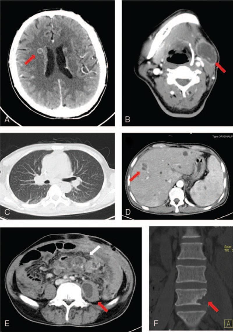 A composite of six computed tomography (CT) scans (A-F) demonstrating multi-organ manifestations of disseminated tuberculosis. (A) Axial brain CT showing a small, ring-enhancing nodule near the right lateral ventricle, consistent with a tuberculoma. (B) Axial neck CT revealing a large mass with peripheral annular enhancement under the left jaw, indicative of a cold abscess or tuberculous lymphadenitis. (C) Axial chest CT displaying diffuse, symmetric miliary nodules throughout both lungs. (D) Axial abdominal CT showing multiple hypoattenuating, ring-enhancing nodules within the liver parenchyma. (E) Axial pelvic CT demonstrating enlarged mesenteric lymph nodes with peripheral enhancement (white arrow) and a low-density fluid collection with annular enhancement in the left psoas major muscle (red arrow), characteristic of a psoas abscess. (F) Coronal CT of the lumbar spine showing focal bone destruction in the L5 vertebra, consistent with Pott disease. This series illustrates the systemic nature of disseminated TB, involving the central nervous system, respiratory system, lymphatic system, viscera, and musculoskeletal system.