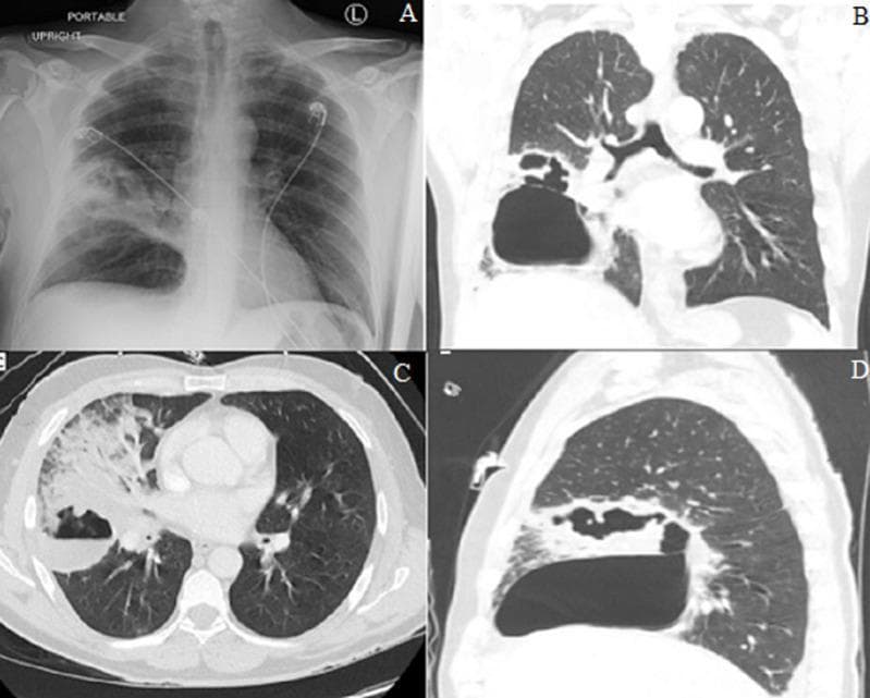 This composite figure presents a radiographic and tomographic evaluation of necrotizing pneumonia with abscess formation in the right lung. Panel A is a portable frontal chest X-ray showing a dense focal infiltrate in the right mid-lung zone involving the minor fissure, with internal lucencies suggestive of early cavitation. Panels B, C, and D are CT lung window images in coronal, axial, and sagittal planes, respectively. These images demonstrate extensive consolidation of the right middle lobe (RML) and right lower lobe (RLL). A large, thick-walled abscess cavity is clearly visible, containing a prominent air-fluid level—a hallmark of pulmonary abscess. The surrounding parenchyma shows heterogeneous attenuation and tissue destruction consistent with necrotizing pneumonia. This visual series illustrates the progression from simple lobar consolidation to complex cavitary disease and the importance of multiplanar CT imaging in characterizing the extent of parenchymal necrosis and abscess localization within specific pulmonary segments.