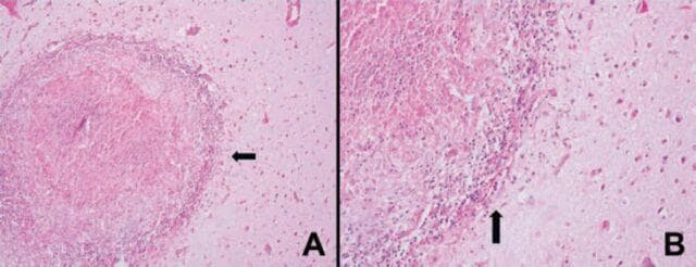 Two-panel light microscopy image of brain (glial) tissue showing necrotizing granulomatous inflammation, commonly associated with conditions like CNS tuberculosis. Image A (200x magnification) displays a well-circumscribed, circular granuloma characterized by a centrally located area of caseous necrosis, which appears as a pale, acellular eosinophilic region. The necrosis is surrounded by a dense peripheral rim of mononuclear inflammatory cells, including lymphocytes and epithelioid histiocytes. Image B (400x magnification) provides a higher-resolution view of the granuloma's border (indicated by black arrows), highlighting the transition from the necrotic core to the hypercellular inflammatory zone and the adjacent glial parenchyma. The H&E staining clearly differentiates the various zones: the central homogenous necrosis, the basophilic ring of active inflammation, and the surrounding reactive glial background. These features are diagnostic hallmarks of chronic granulomatous disease within the central nervous system.