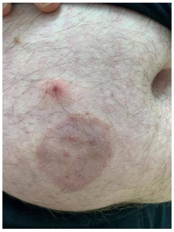 This clinical photograph displays a dermatological presentation of tinea corporis (zoonotic dermatophytosis) on the abdomen of an adult male. The primary feature is a well-circumscribed, annular, erythematous plaque approximately 4-5 cm in diameter. The lesion exhibits a classic 'ringworm' morphology with a slightly raised, scaly inflammatory border and a partially cleared central area containing subtle papular elements. Superior to the primary plaque is a secondary, smaller, raised erythematous papule with a central punctum or crust. The surrounding skin shows mild diffuse erythema and scattered smaller inflammatory macules. Hair follicles are visible throughout the affected and unaffected regions. This image serves as an educational example of fungal infection (likely Trichophyton mentagrophytes) transmitted from a pet (guinea pig) to a human host, emphasizing the visual diagnostic features of annular inflammatory skin lesions.