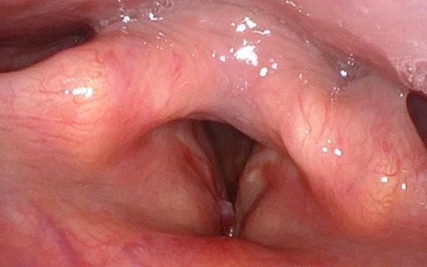 This diagnostic endoscopic image, obtained via fibrolaryngoscopy, provides a superior view of the larynx, focusing on the glottis. A distinct, pedunculated polypoid lesion is visible on the anterior third of the right vocal cord, situated near the anterior commissure. The lesion exhibits a smooth surface with prominent vascularization, characteristic of an angiomatous appearance. While the mass partially encroaches upon the glottic aperture, the airway space remains largely patent. The contralateral (left) vocal cord appears healthy with normal mucosal color and texture. There is no evidence of diffuse inflammation or significant structural distortion of the surrounding laryngeal tissues. This clinical photograph is used in otolaryngology to identify benign and malignant laryngeal masses, such as inflammatory myofibroblastic tumors or angiomatous polyps, and to assess their impact on vocal fold mobility and airway patency.