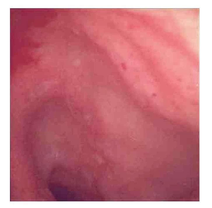 This diagnostic endoscopic image captures the terminal ileum during a colonoscopy, highlighting mucosal manifestations of inflammatory bowel disease, specifically Crohn's disease. The image reveals significant mucosal erythema and diffuse edema, giving the tissue a predominantly reddish-pink appearance. Distinct pathological features include multiple shallow, irregular erosions and superficial breaks in the mucosal lining. Small, petechial-like red spots and textural irregularities are visible across the surface, indicating active inflammation and patchy acute-on-chronic inflammatory changes. These visual markers are critical for the endoscopic assessment of ileitis and help differentiate inflammatory conditions from infectious etiologies such as tuberculosis. The visual evidence of mucosal disruption without obvious granulomata on initial inspection serves as an educational example of the diverse endoscopic presentations of ileal Crohn's disease.